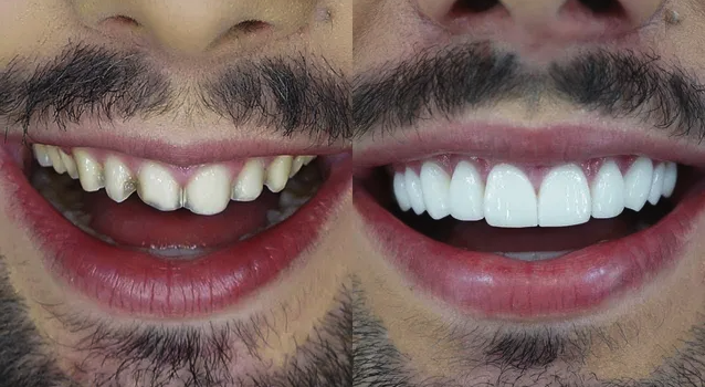 Antes e depois de sorriso 1